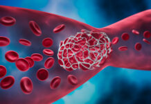 Beware Blood Clots: What Are the Symptoms?